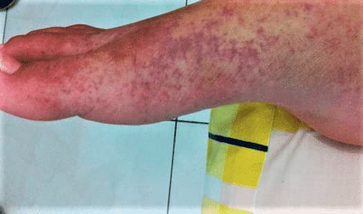 infezione da Chikungunya