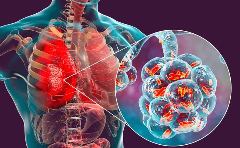 legionella